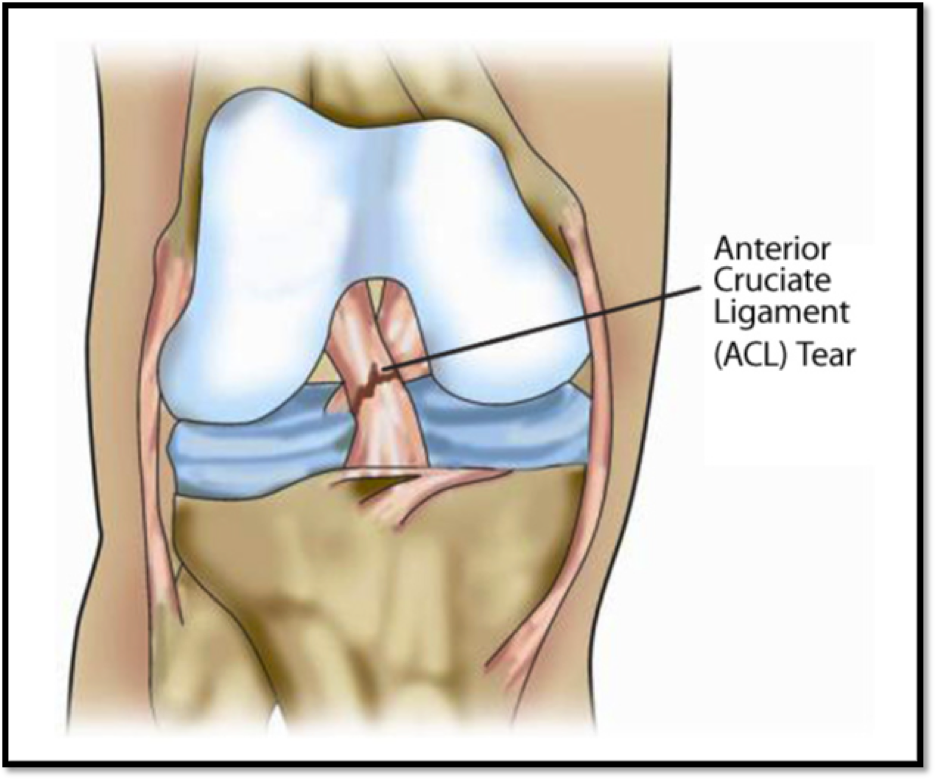 What are the symptoms after an ACL injury?