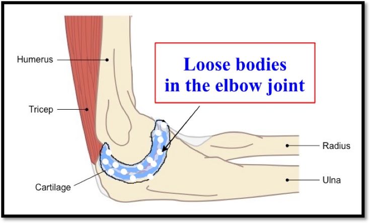 Best Elbow Surgeon in Surat | Elbow Treatments in Surat