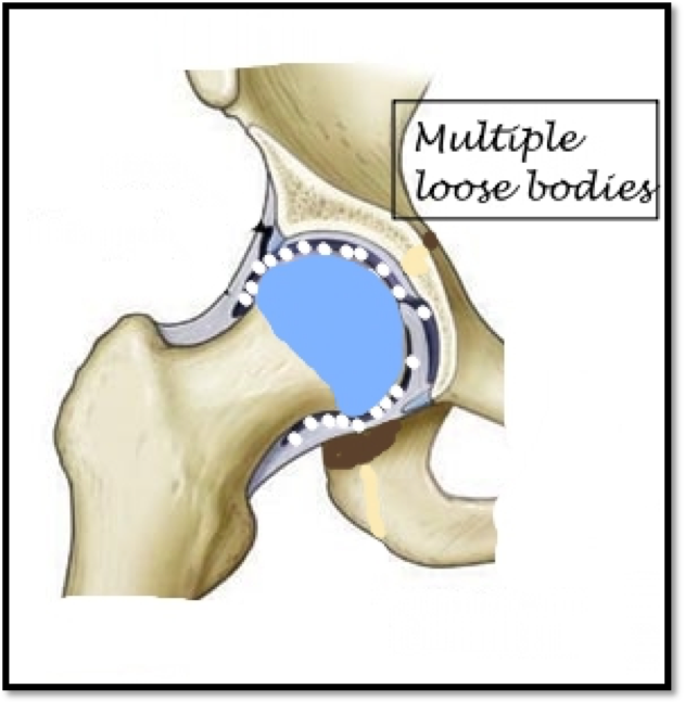 Best Hip Replacement Treatments in Surat Dr. Nandan Rao